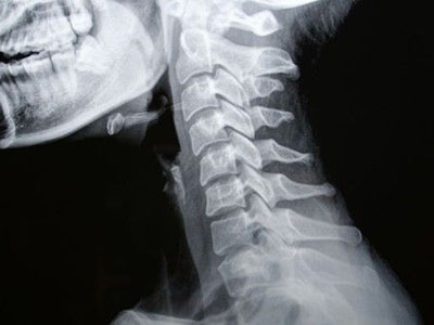 外傷性頸椎病整脊復位注意事項