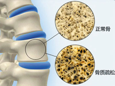 腰椎骨質增生的治療方法