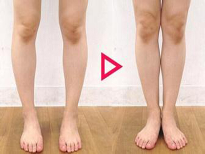 O型腿的日常矯正方法