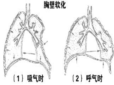 連枷胸快速康復治療