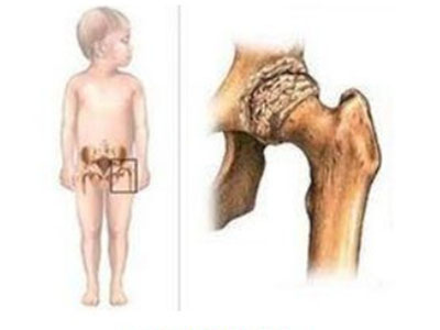 兒童股骨頭壞死康復鍛煉方法
