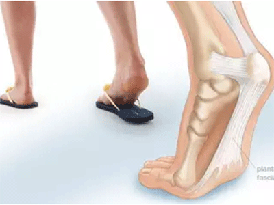 足底筋膜炎康復及治療