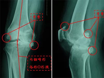 爸媽老了，腿也老了，一走路腿就疼，到底該怎麼辦？