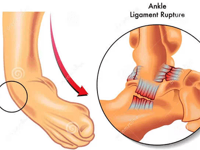 足踝運動損傷的深度剖析