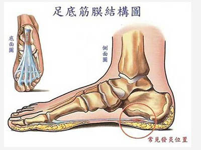 足底筋膜炎的康復方案