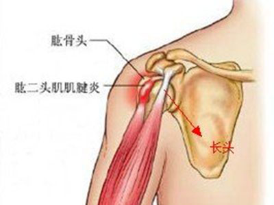 肱二頭肌肌腱炎