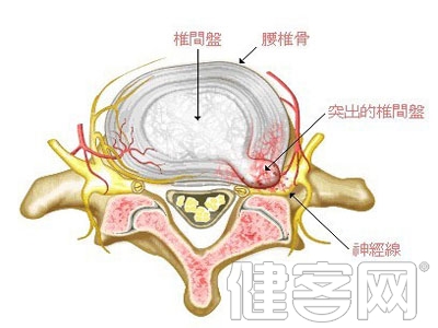 早發現早治療 腰椎間盤突出