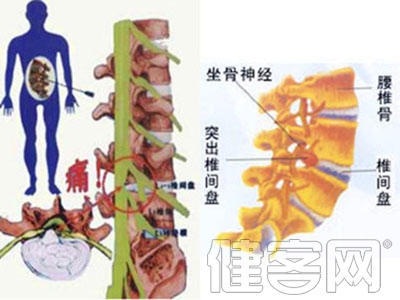 腰椎間盤突出 矯正“地基”很關鍵