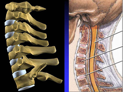 針灸法治療頸椎骨質增生