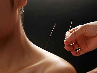 肩周炎的治療方法 有效的針灸治療