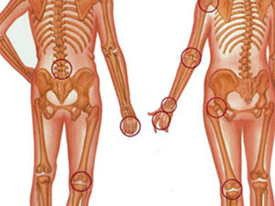 膝關節增生性關節炎可以使用中藥
