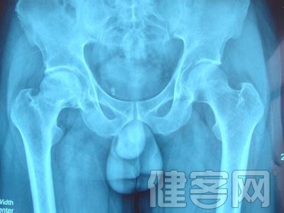 四種治療股骨頭壞死的中藥偏方