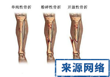 骨折修復過程 骨折的修復過程 骨折如何修復