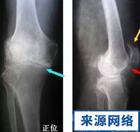 膝關節 骨質增生 治療 膝關節疼痛